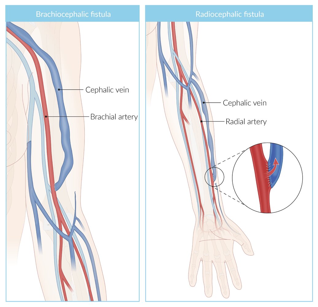 Arteriovenous fistulas for hemodialysis