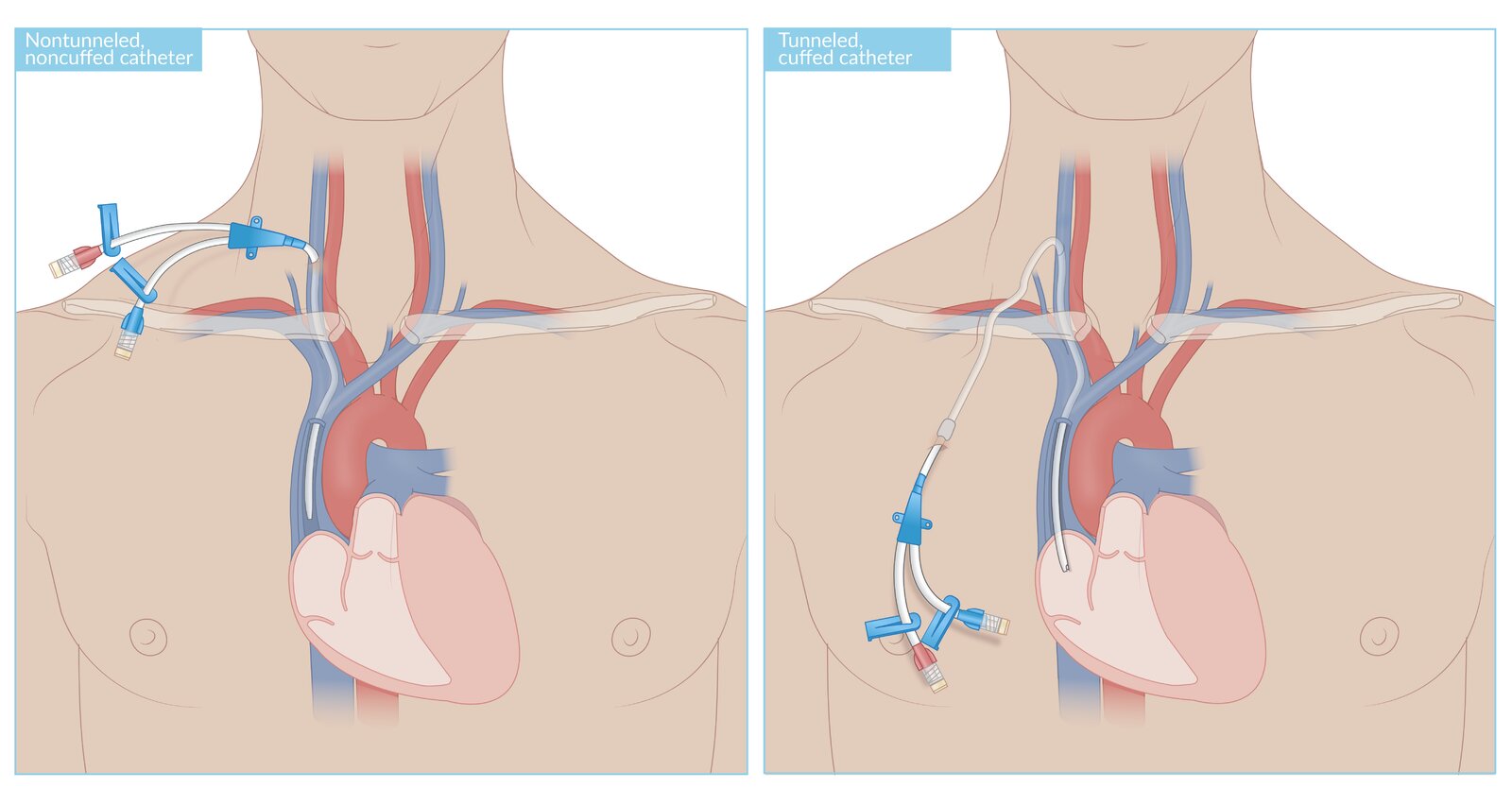 Central venous catheters for renal replacement therapy