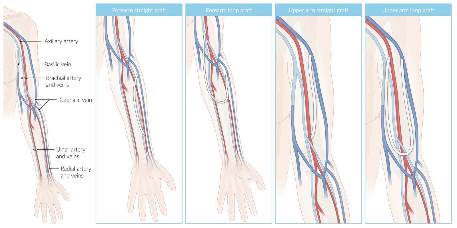 Arteriovenous grafts for hemodialysis