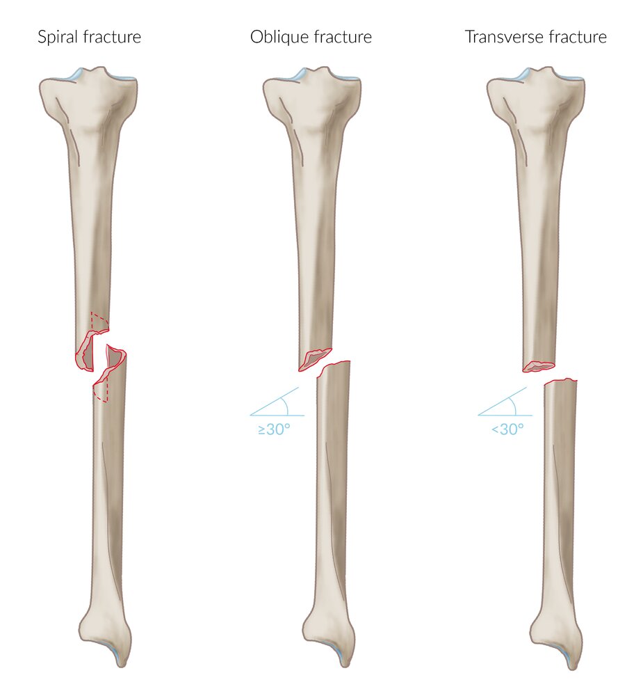 Fracture orientation