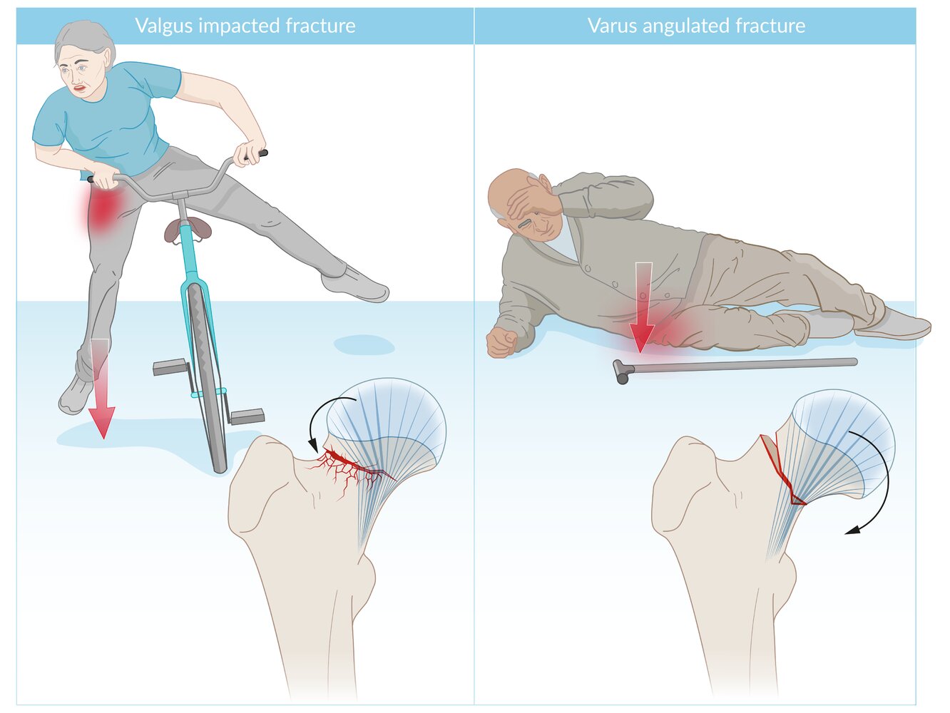Femoral neck fracture mechanisms