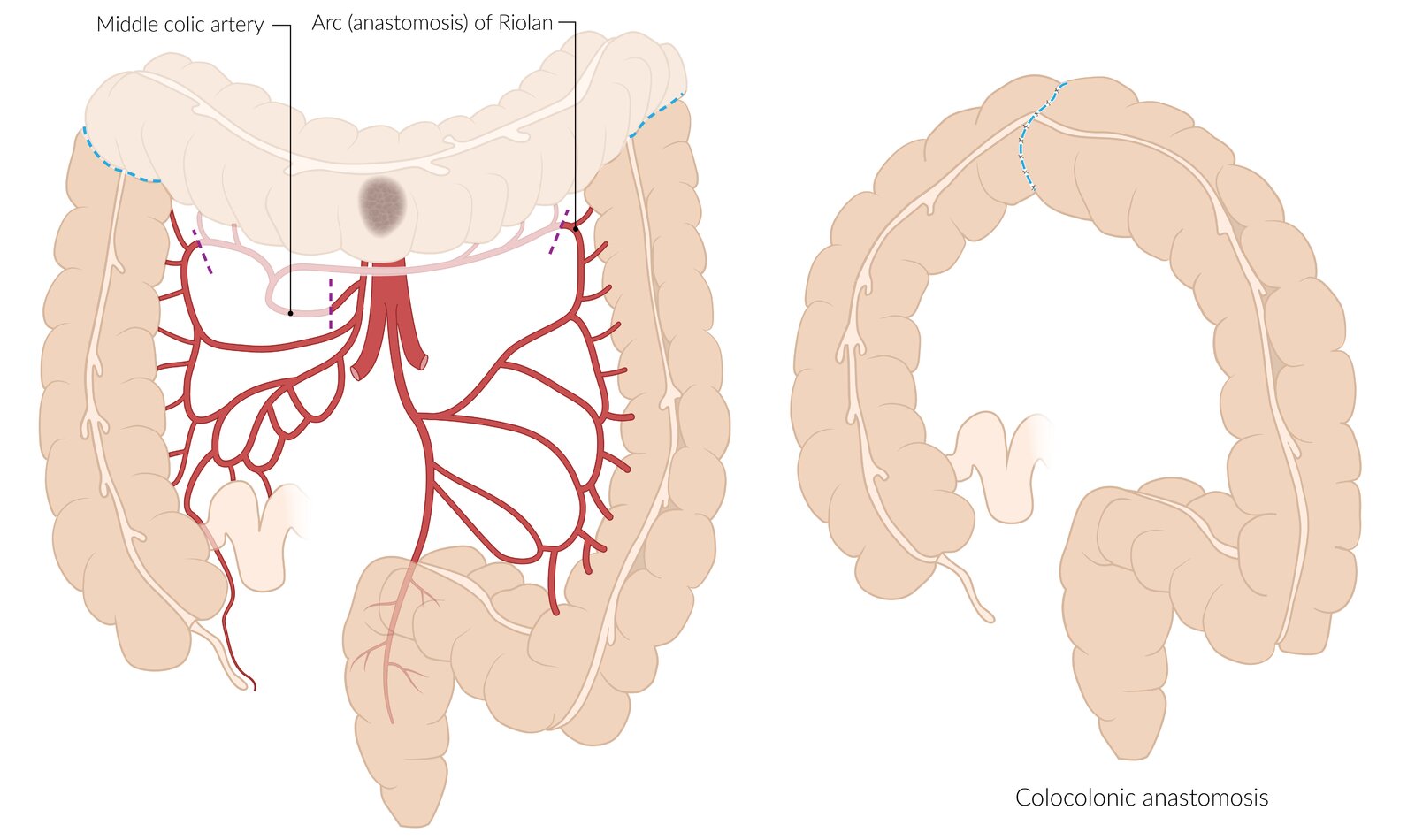 Transverse colectomy