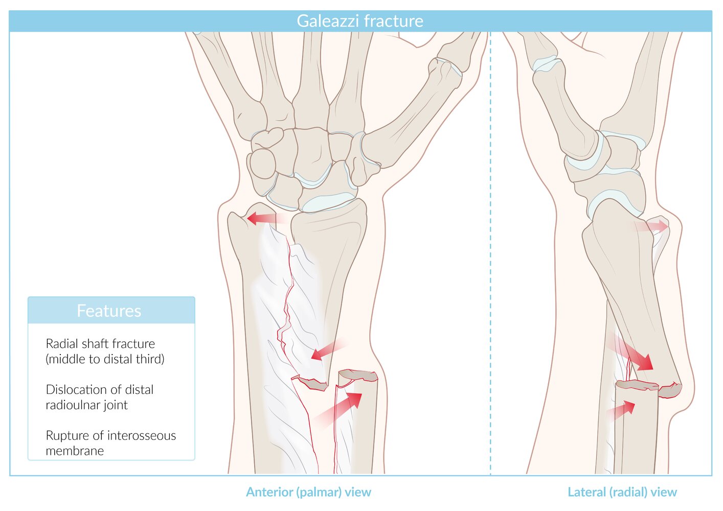 Galeazzi fracture