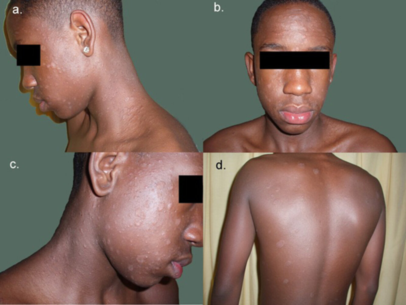 Pityriasis rosea