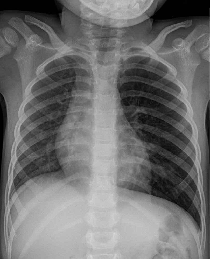 Foreign body aspiration