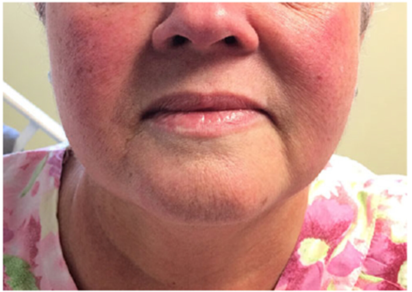 Vancomycin flushing reaction