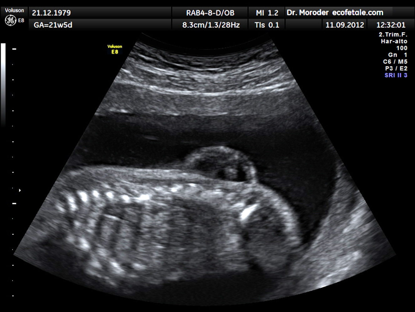 Myelomeningocele on fetal ultrasound