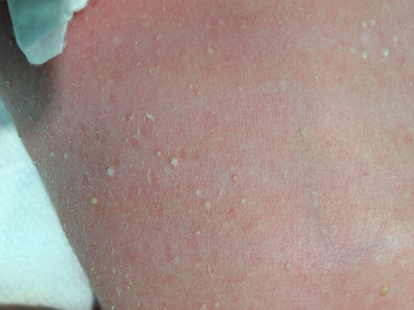 Transient neonatal pustular melanosis