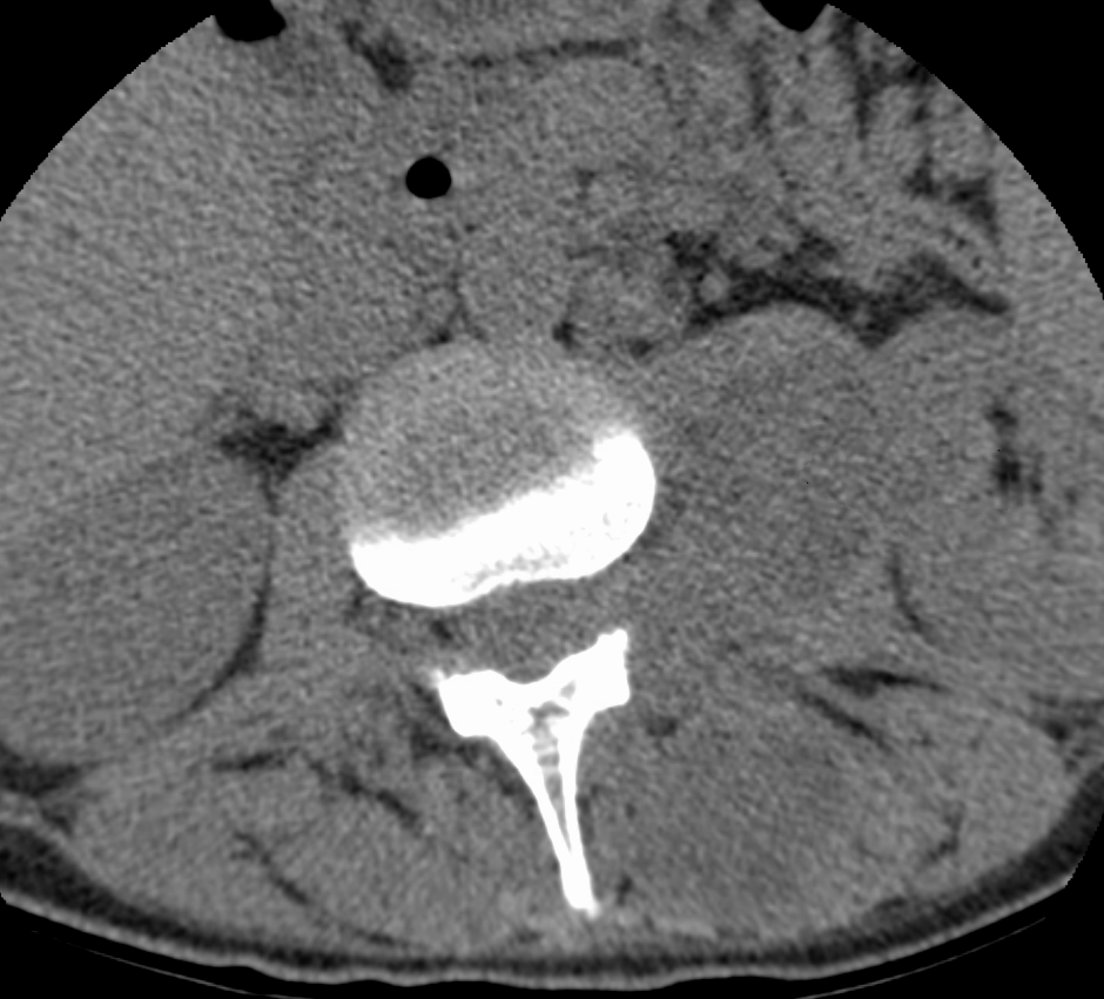 Psoas abscess