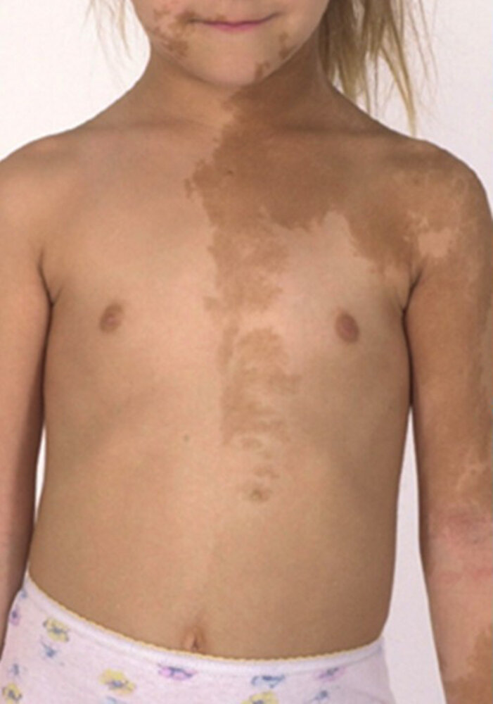 McCune-Albright syndrome