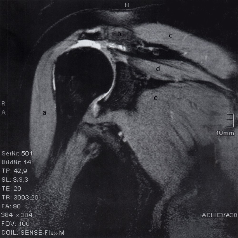 Supraspinatus tendon tear (rotator cuff tear)