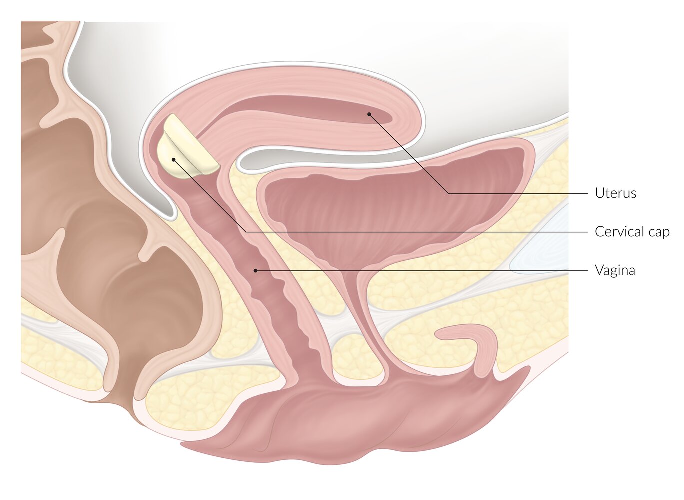 Cervical cap