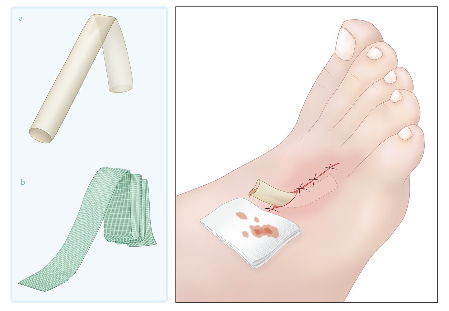 Open wound drainage system