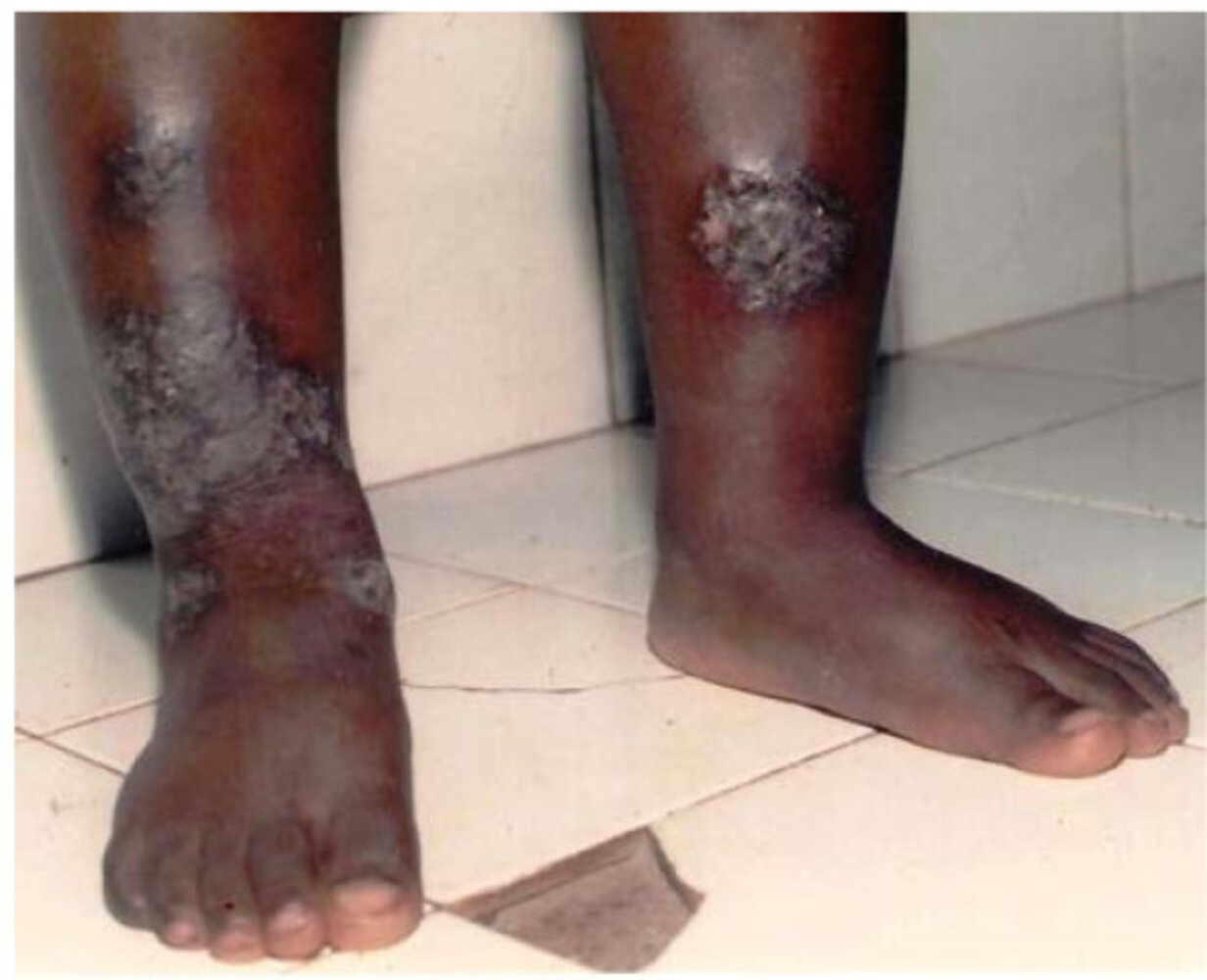 Nummular eczema
