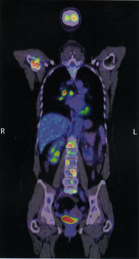 PET-CT scan of metastatic lung cancer