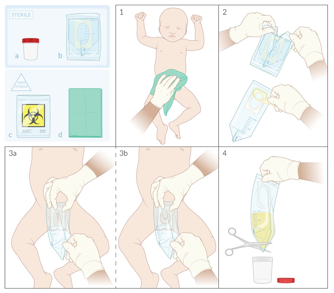 Bagged urine collection technique in infants
