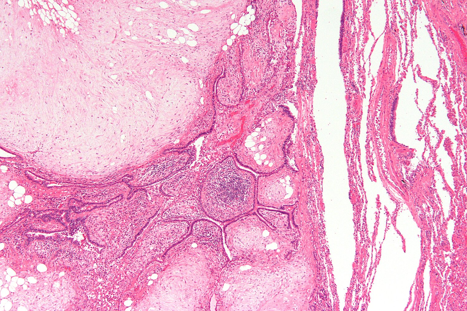 Pulmonary hamartoma