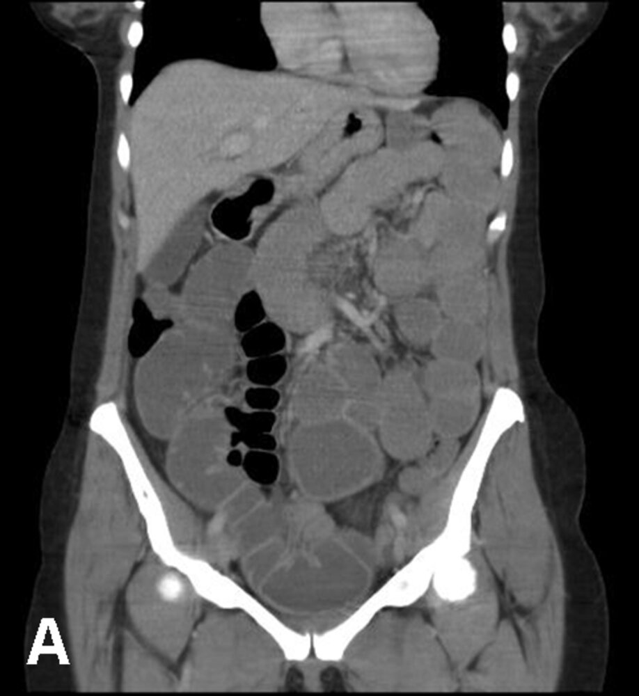 Small bowel obstruction