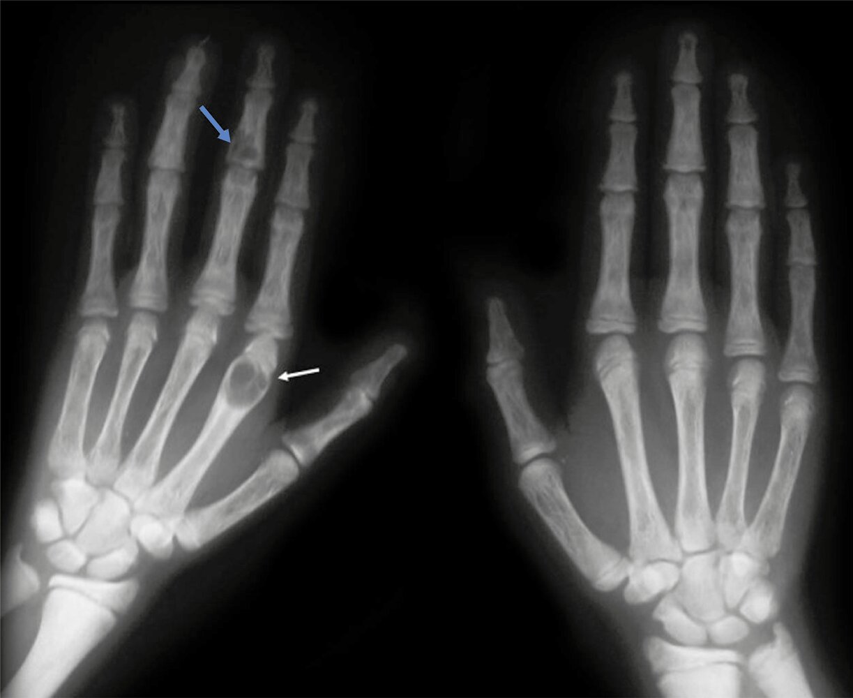 Osteitis fibrosa cystica