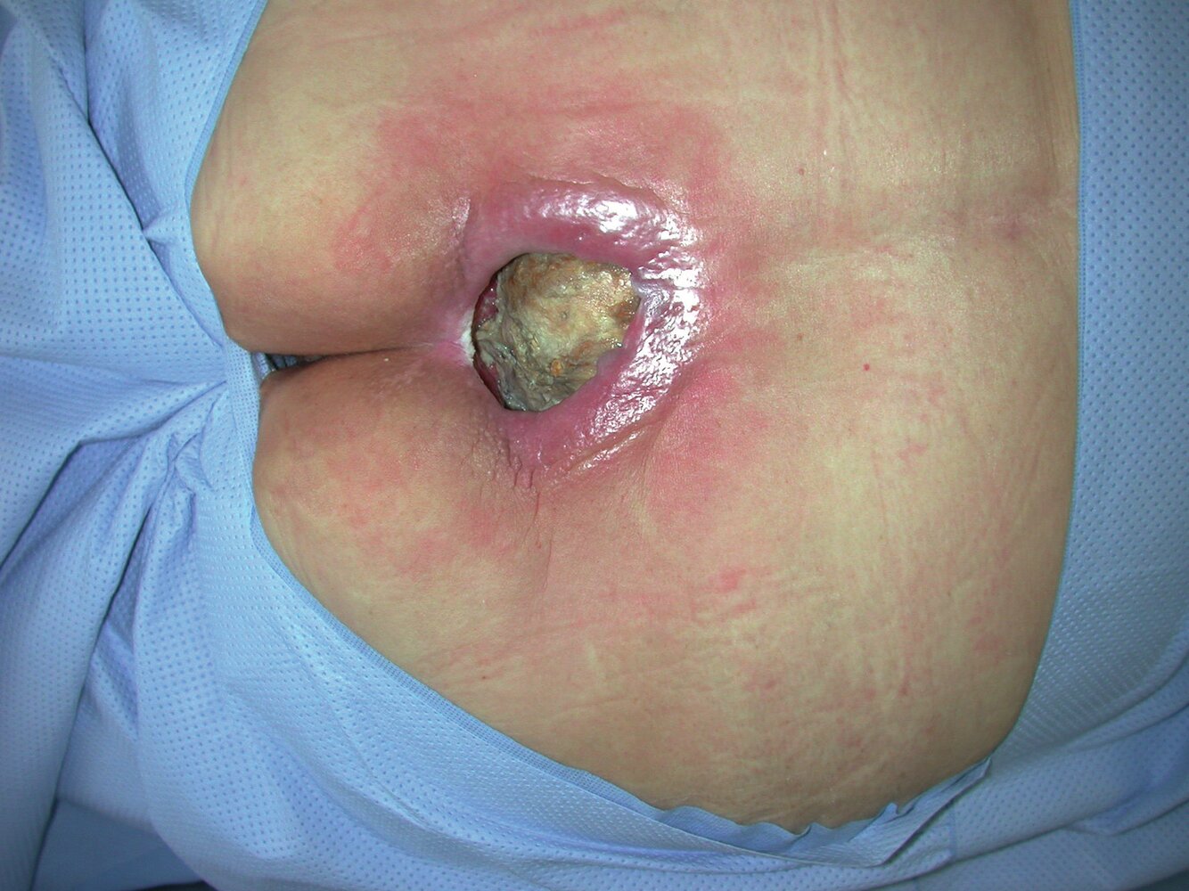 Stage 4 decubitus (pressure) ulcer