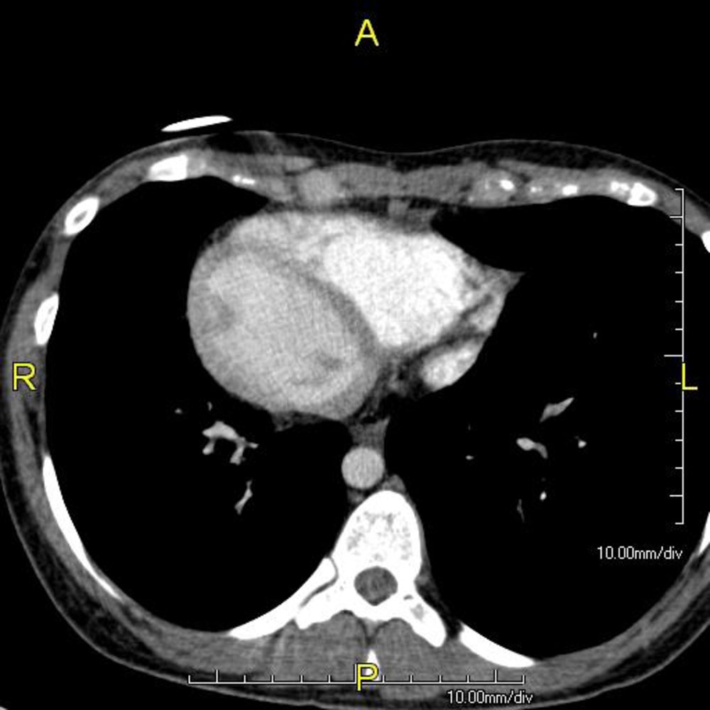 Dextrocardia in Kartagener syndrome