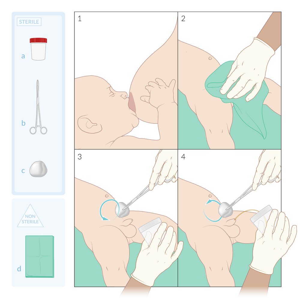 Voiding stimulation technique for clean-catch urine in infants