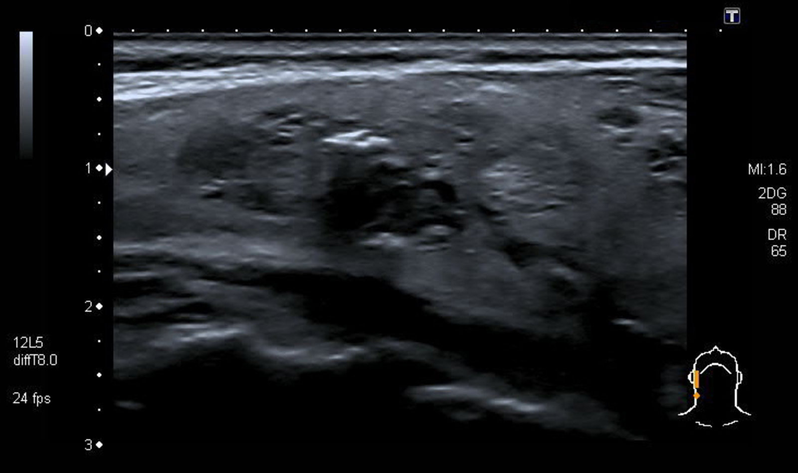Mixed cystic and solid thyroid nodule
