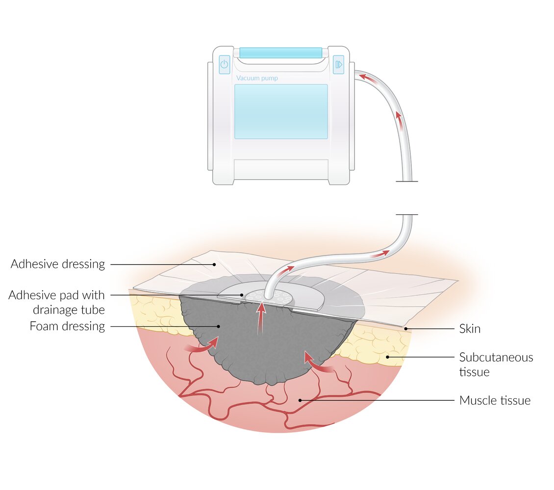 Negative pressure (vacuum-assisted) wound therapy: principles