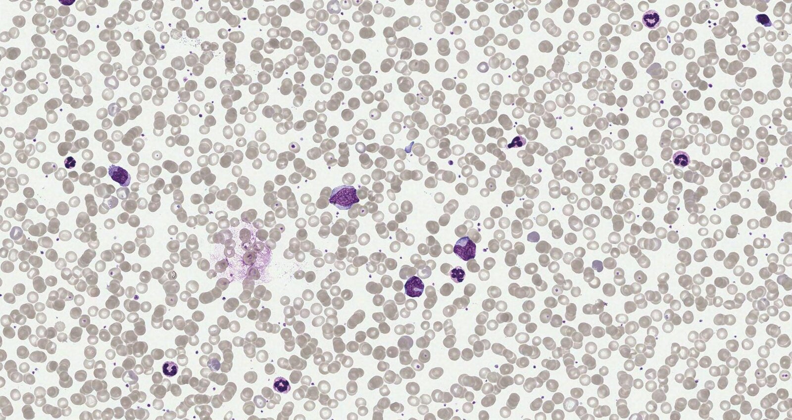 Diffuse large B-cell lymphoma