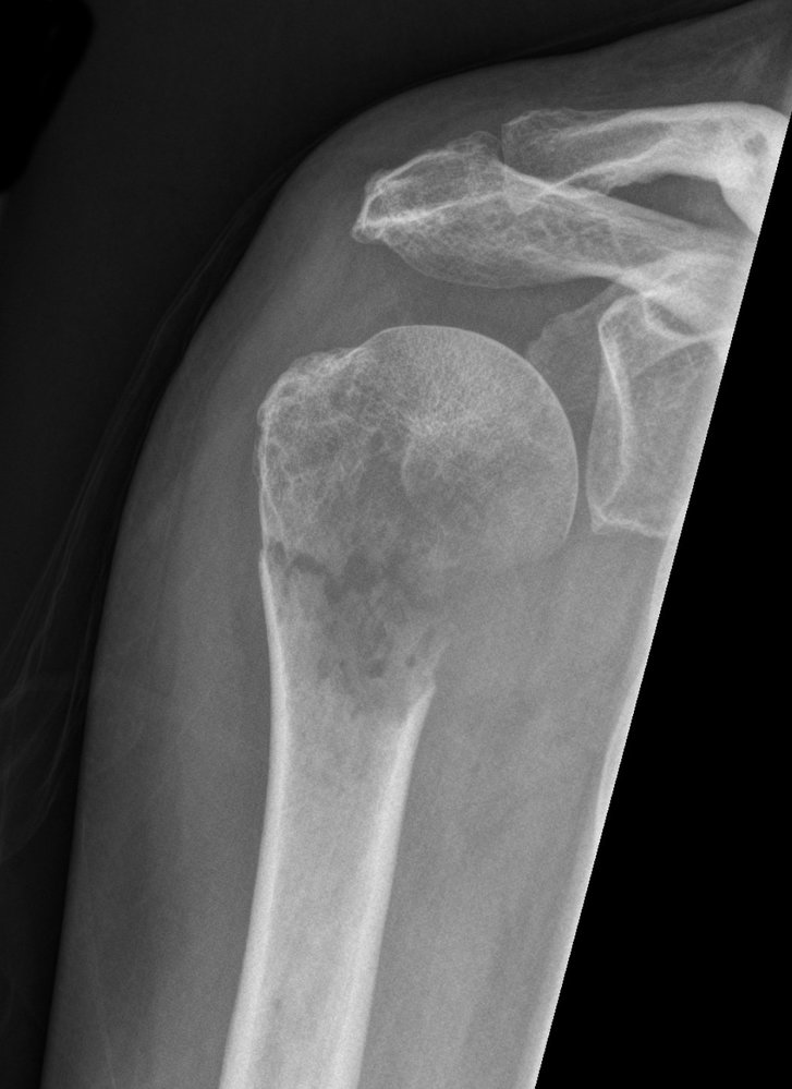 Pathologic fracture