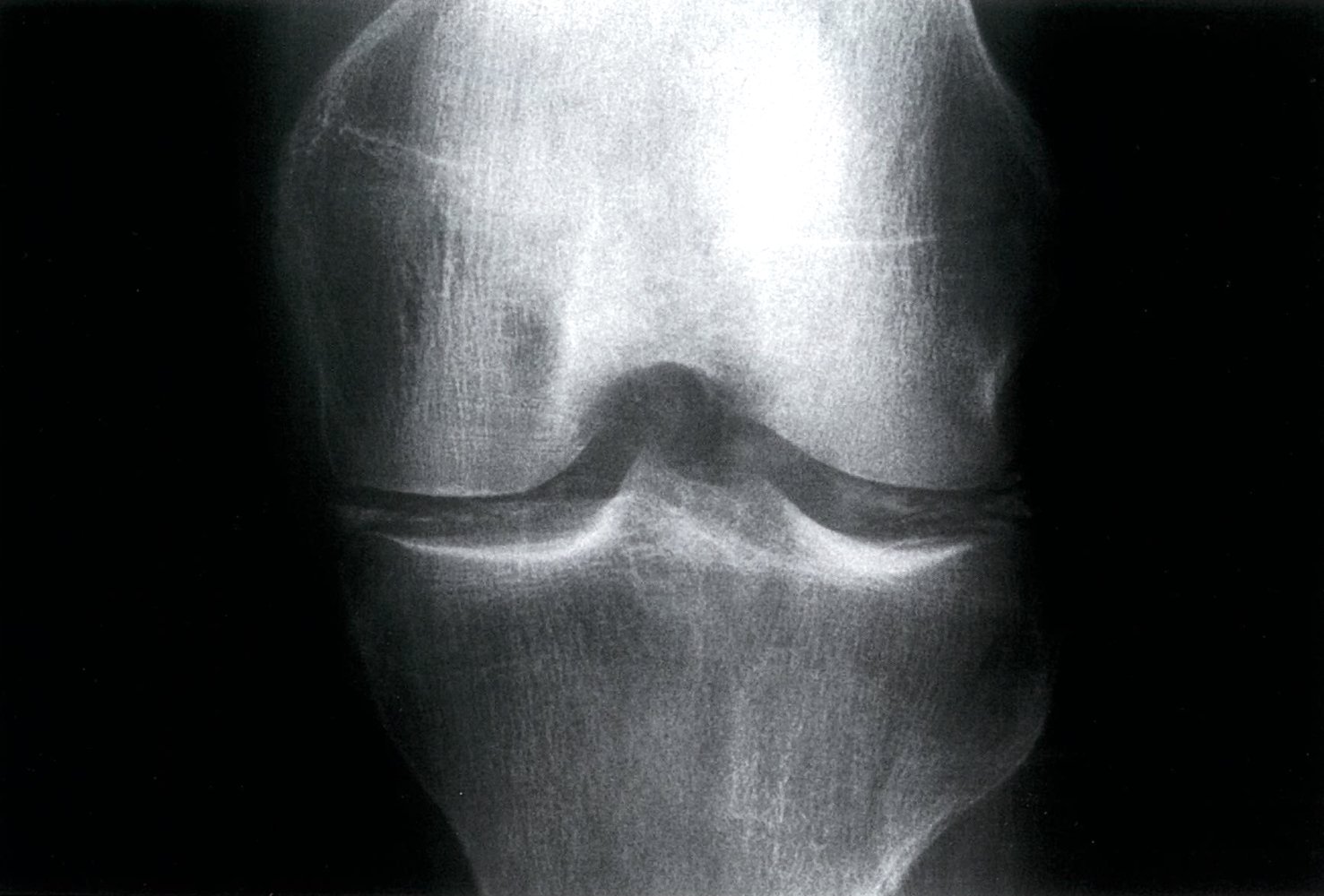 Chondrocalcinosis