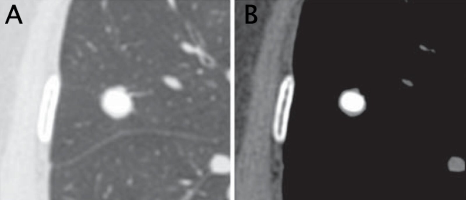Calcified granuloma