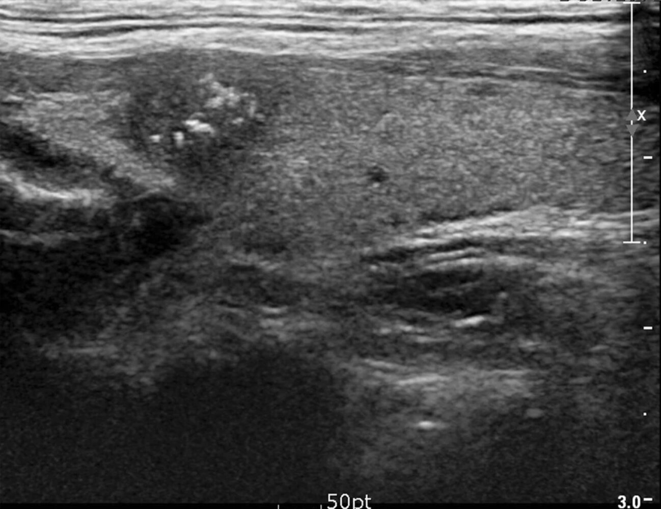 Solid thyroid nodule with microcalcifications
