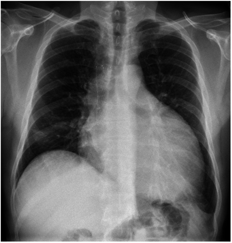 Pericardial effusion