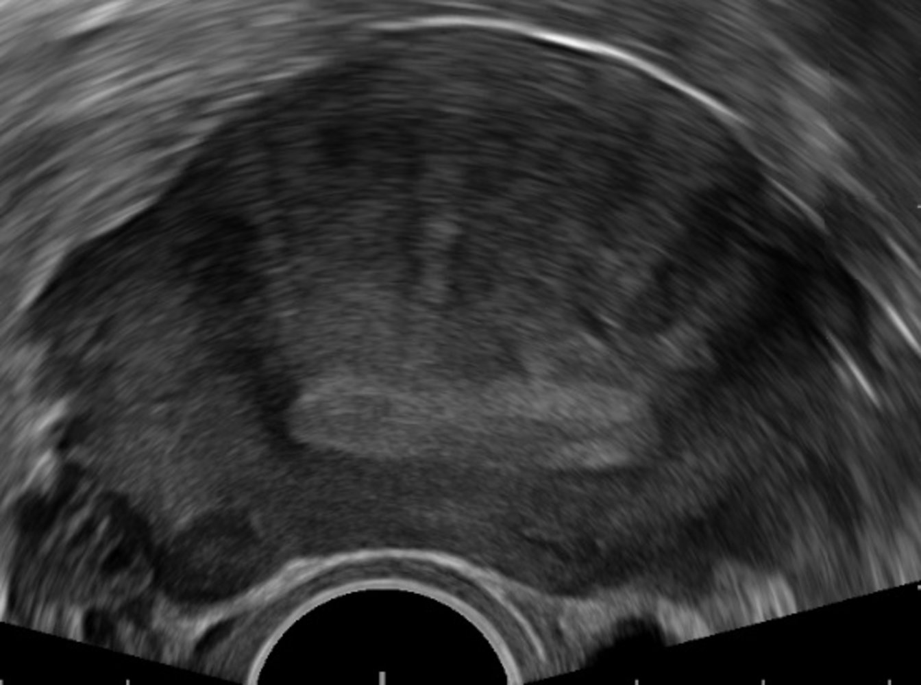 Focal uterine adenomyosis