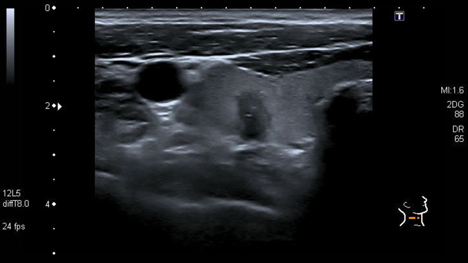 Suspicious thyroid nodule