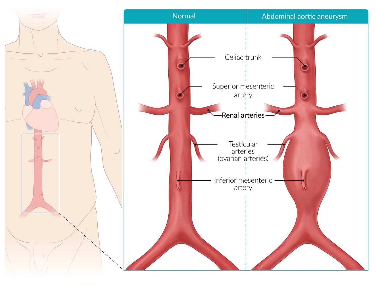 Typical abdominal aortic aneurysm