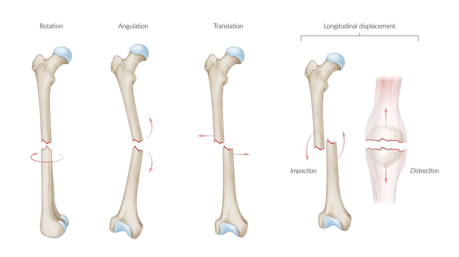 Types of fracture displacement
