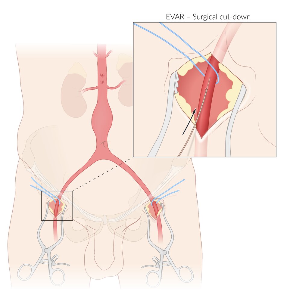 Arterial access for endovascular aneurysm repair (EVAR) of abdominal aortic aneurysm (AAA)