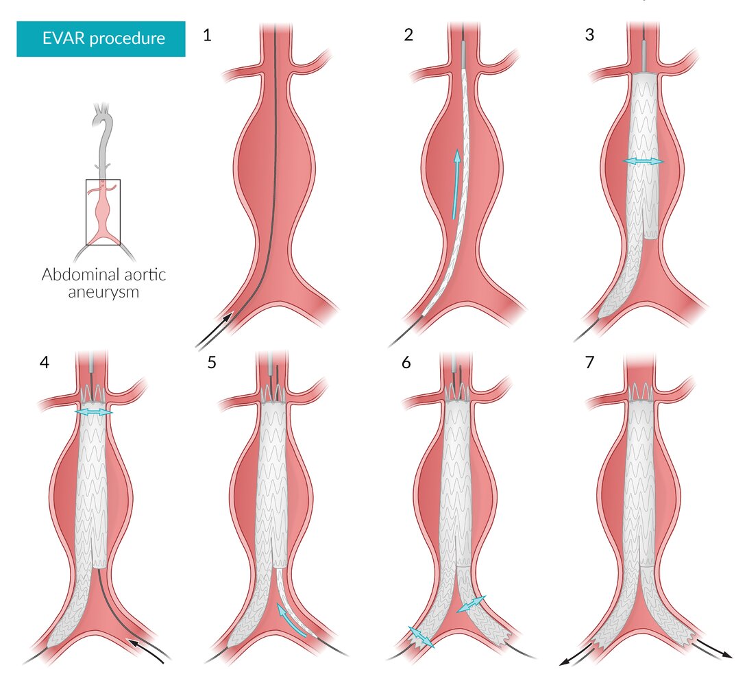 Endovascular aneurysm repair (EVAR) of abdominal aortic aneurysm (AAA)