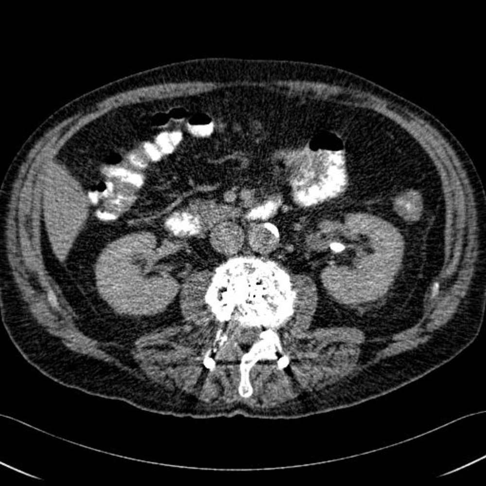 Nonobstructive renal calculus (1/2)