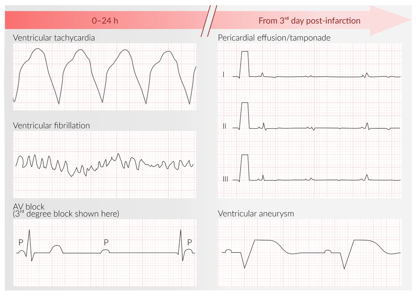 ECG findings in complications of acute myocardial infarction