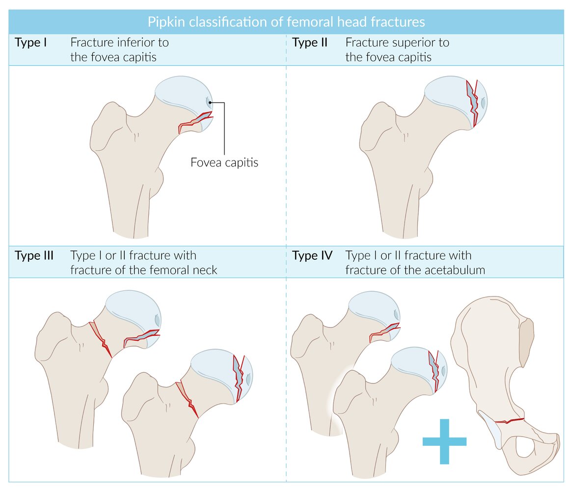 Pipkin classification of femoral head fractures