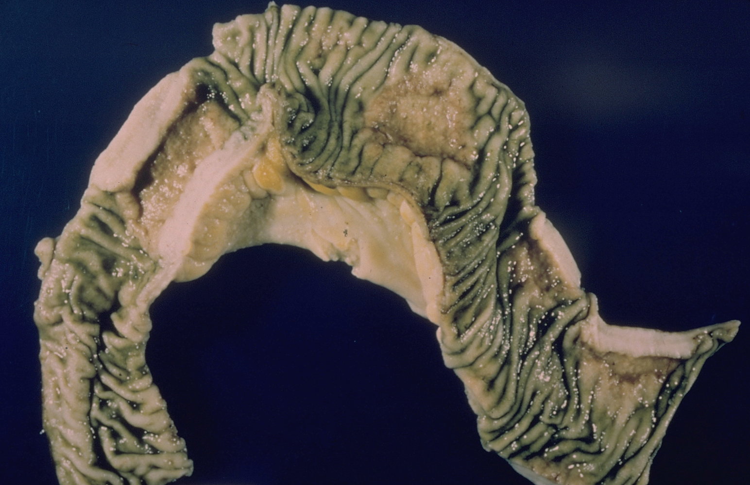 Intestinal tuberculosis (small intestine)