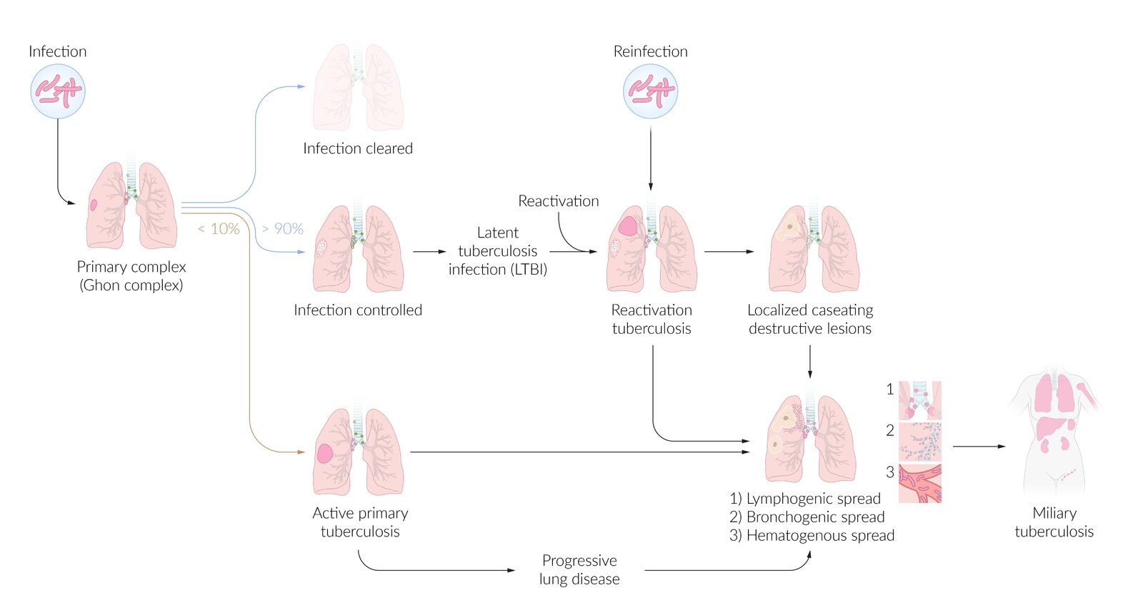 Stages of pulmonary tuberculosis