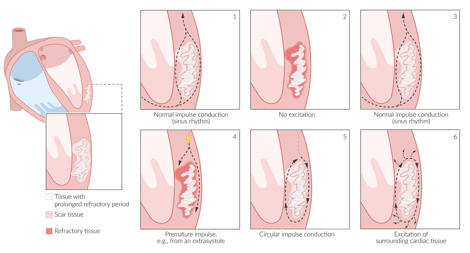 Cardiac reentry mechanism
