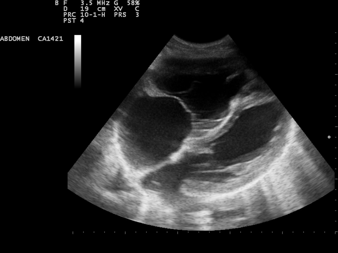 Dilated right heart with right ventricular strain