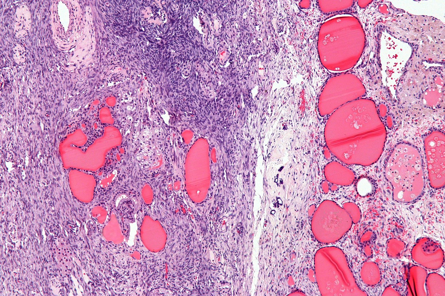 Struma ovarii