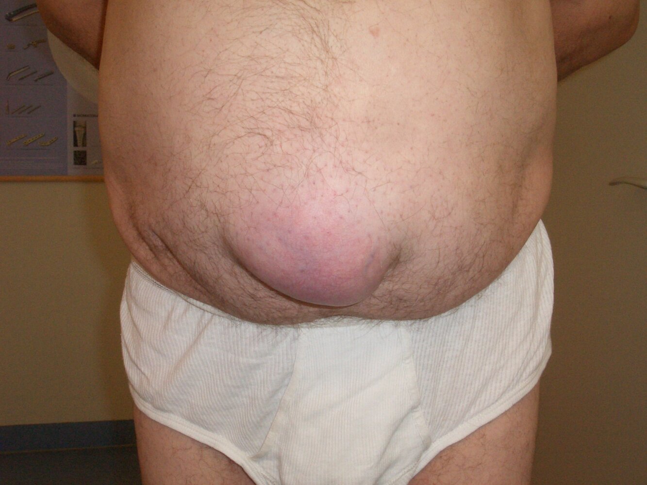 Paraumbilical hernia