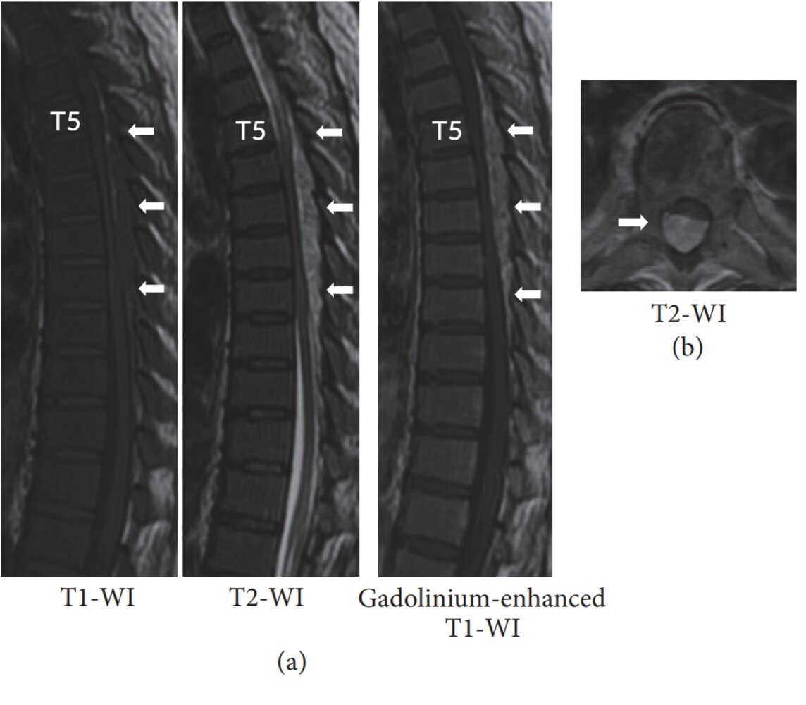 Spinal epidural mass